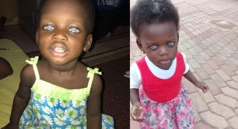 This African girl born with blue eyes is a victim of ignorance